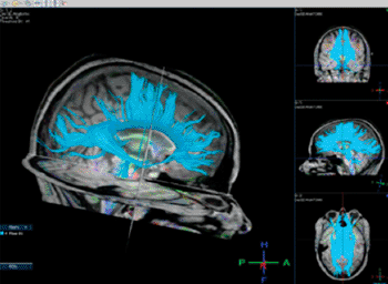 Image: Diffusion tensor image showing white matter fibers (in blue) that were found to be affected by heading. Credit: Albert Einstein College of Medicine. Image: Diffusion tensor image showing white matter fibers (in blue) that were found to be affected by heading. Credit: Albert Einstein College of Medicine.